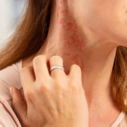A person scratching their neck, showing red, irritated skin possibly due to a rash or allergic reaction. They wear a light pink shirt and have shoulder-length brown hair.