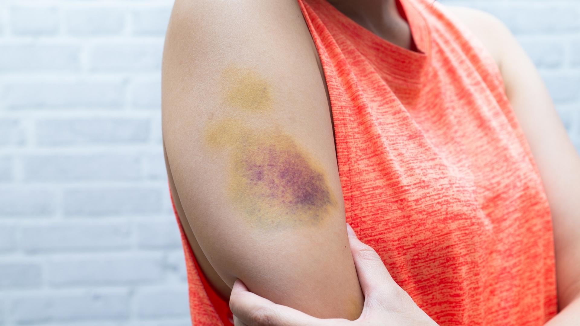 How to Make a Bruise Stop Hurting