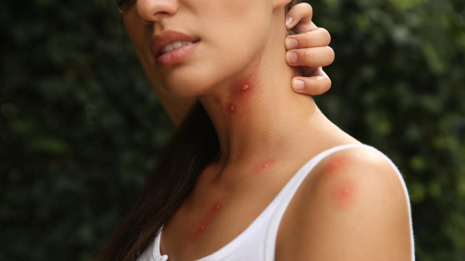 First Aid for Insect Bites and Stings Coast2Coast