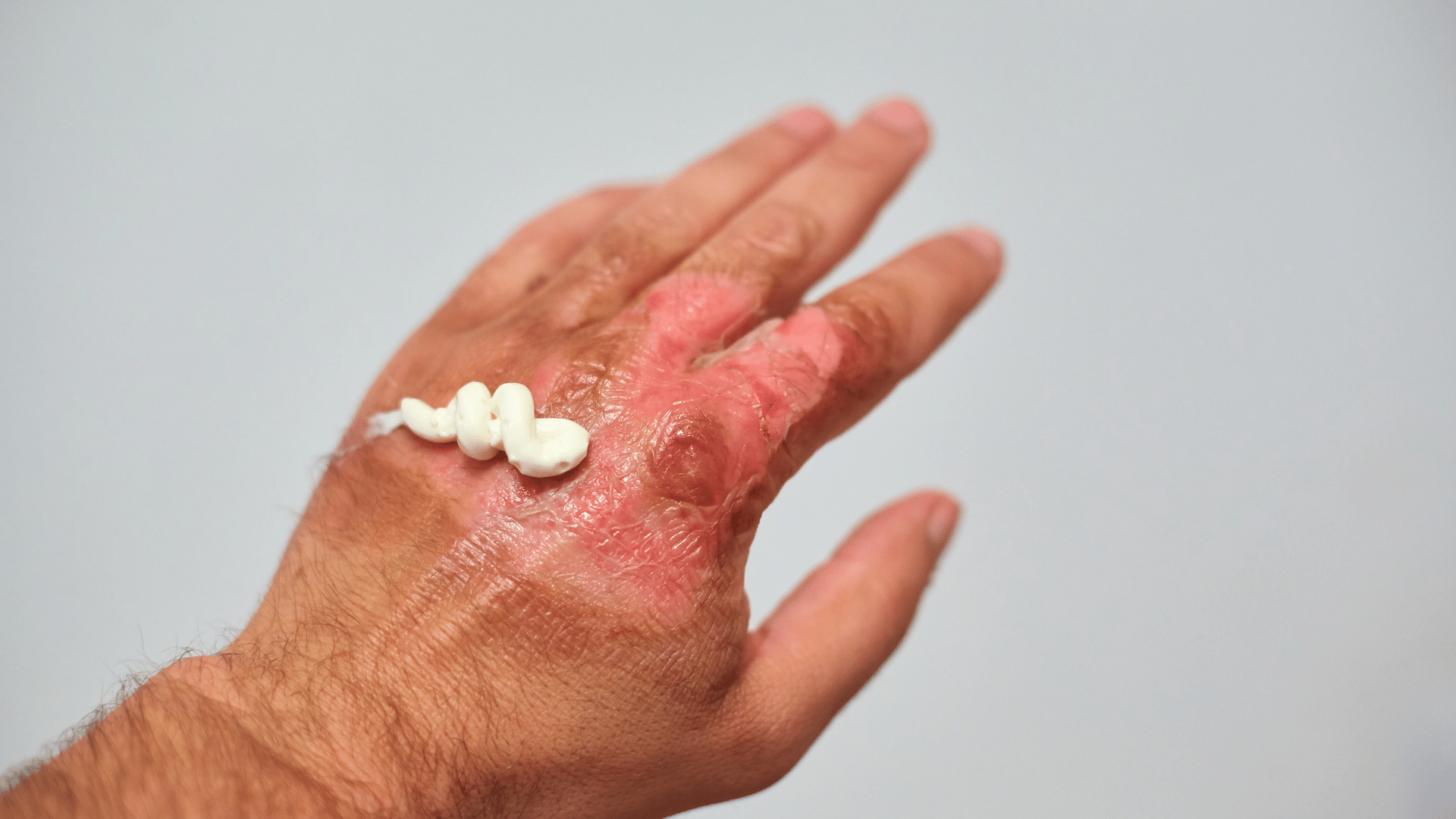Ointment on Burn on Hand.