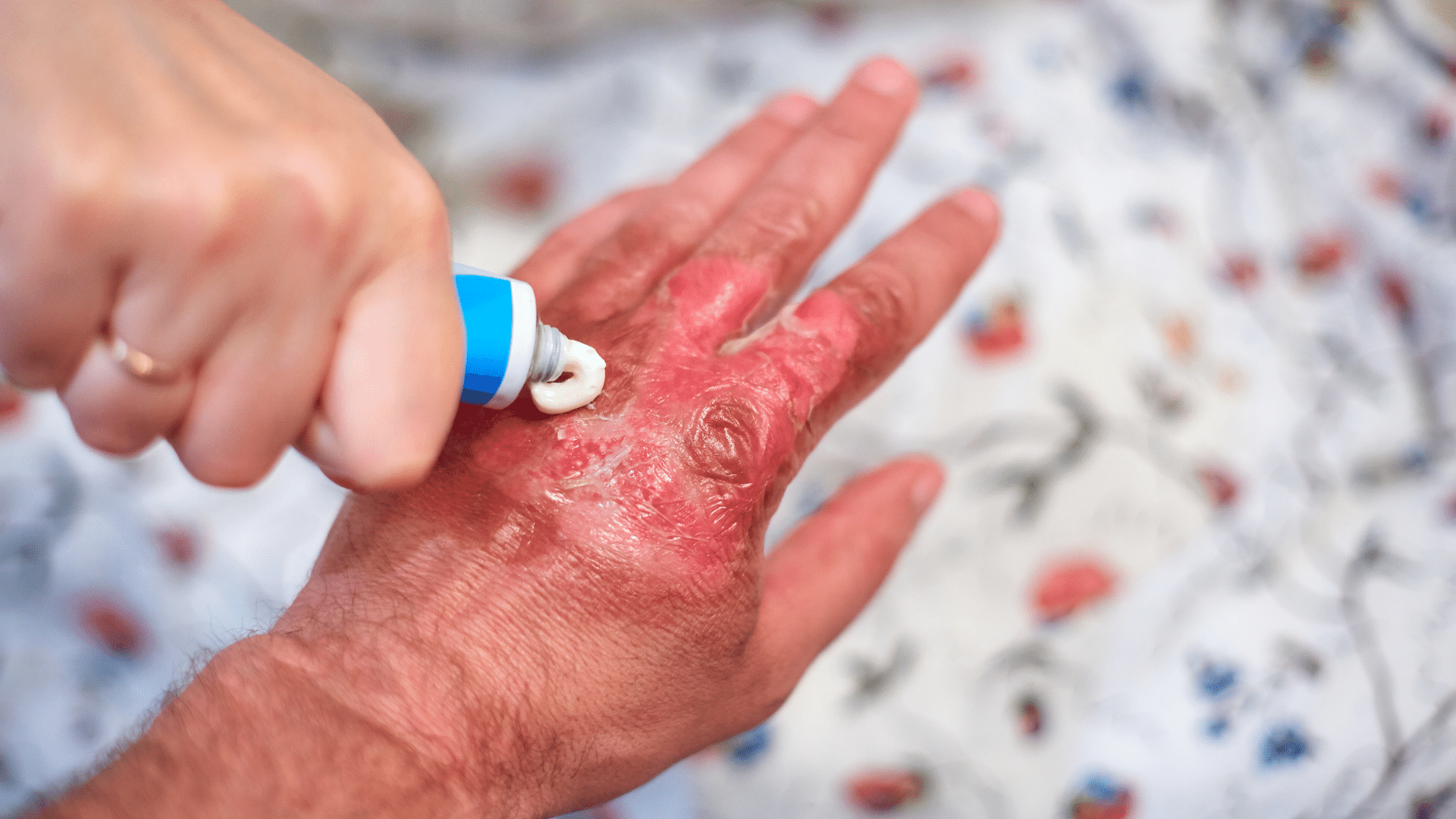 Person applying ointment for a burn on hand.