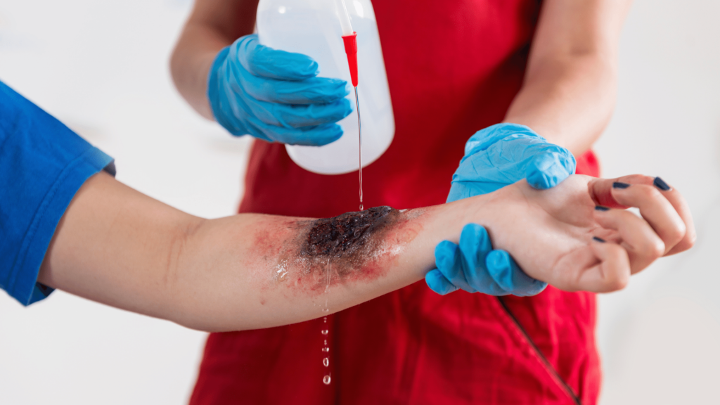 Person giving First Aid for burn on hand.