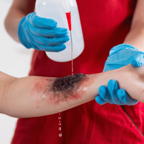 Person giving First Aid for burn on hand.