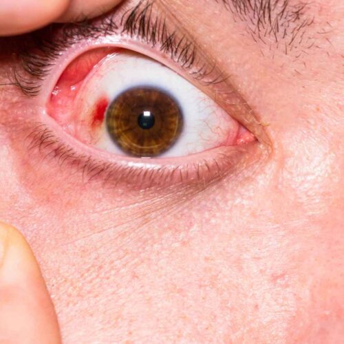 First aid for eye injuries