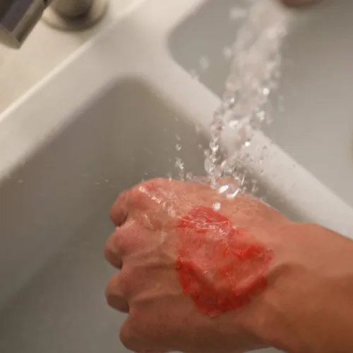 treating a burn injury